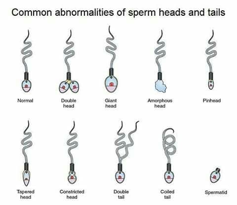 Sperm Anomalies
